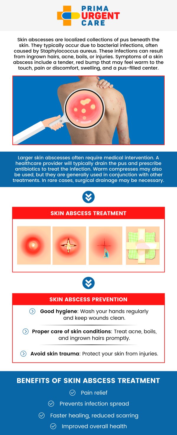 An abscess is a painful, swollen area filled with pus caused by infection. At Prima Urgent Care, our experienced healthcare professionals specialize in diagnosing and treating abscesses quickly and effectively. Our team offers advanced procedures to drain abscesses safely, ensuring a quick and effective recovery. We are dedicated to providing fast, professional care for your health needs. For more information, contact us today or book an appointment online. We are conveniently located at 3903 Fair Ridge Dr Suite Q, Fairfax, VA 22033. An abscess is a painful, swollen area filled with pus caused by infection. At Prima Urgent Care, our experienced healthcare professionals specialize in diagnosing and treating abscesses quickly and effectively. Our team offers advanced procedures to drain abscesses safely, ensuring a quick and effective recovery. We are dedicated to providing fast, professional care for your health needs. For more information, contact us today or book an appointment online. We are conveniently located at 3903 Fair Ridge Dr Suite Q, Fairfax, VA 22033.