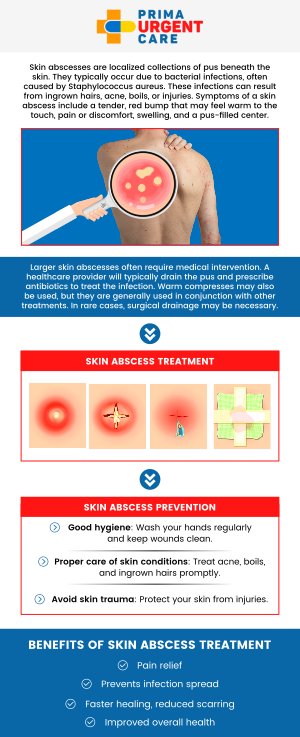 When recovering from an abscess, it’s important to understand the healing stages. The process typically begins with the formation of the abscess, followed by drainage and the reduction of infection. At Prima Urgent Care, our professional team is here to monitor your healing progress, provide guidance, and ensure the area is properly cared for. For more information, contact us or book an appointment online. We are conveniently located at 3903 Fair Ridge Dr Suite Q, Fairfax, VA 22033. When recovering from an abscess, it’s important to understand the healing stages. The process typically begins with the formation of the abscess, followed by drainage and the reduction of infection. At Prima Urgent Care, our professional team is here to monitor your healing progress, provide guidance, and ensure the area is properly cared for. For more information, contact us or book an appointment online. We are conveniently located at 3903 Fair Ridge Dr Suite Q, Fairfax, VA 22033.