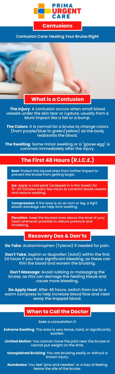 Common Questions Asked by Patients: What is the difference between a contusion and a bruise? Is a contusion a serious injury? What are the 3 types of contusions?

Contusions, or bruises, occur when blood vessels under the skin are damaged, leading to swelling, pain, and discoloration. At Prima Urgent Care, our medical team provides prompt treatment for contusions, focusing on pain relief and reducing swelling. Treatment may include ice application, elevation, and over-the-counter medications to manage discomfort. In some cases, further evaluation is provided to rule out more serious injuries, ensuring the best care for a quick recovery. For more information, contact us today or book an appointment online. We are conveniently located at 3903 Fair Ridge Dr Suite Q, Fairfax, VA 22033. We serve patients from Fairfax VA, South Riding VA, Dulles VA, Chantilly VA, Stone Ridge VA, Oakton VA, Legato VA, Burke VA, Oak Hill, Lees Corner VA & BEYOND! Our Fairfax location is close to Fair Oaks Hospital, Fair Oaks Mall, and Greenbriar Shopping Center.