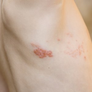Shingles Treatment Clinic in Fairfax, VA