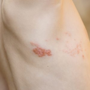 Shingles Treatment Clinic in Fairfax, VA
